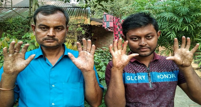 Amal dan Apu Sarker menunjukkan telapak tangannya yang halus tanpa sidik jari (Foto: BBC)