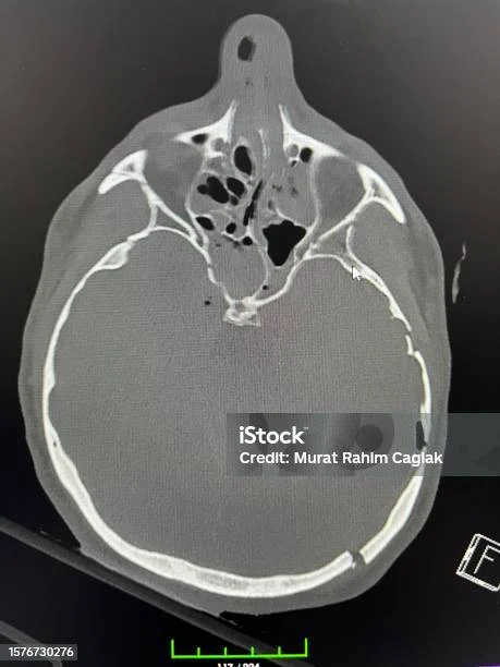 Bayi Baru Lahir dengan Patah Tulang Tengkorak Alami dan Perdarahan Otak, Kisah Mengharukan dan Tantangan Medis