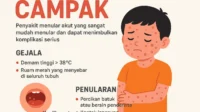 Mengenal Risiko Campak pada Orang Dewasa: Apakah Bisa Terkena Dua Kali?